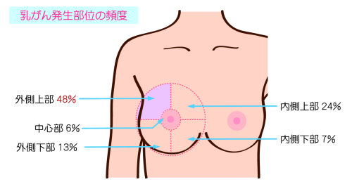乳がん発症部位
